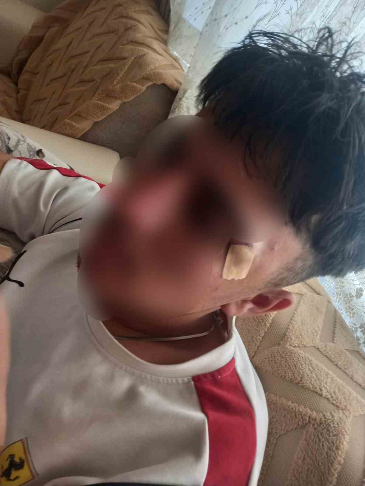 ÖĞRETMENİN KAFA ATTIĞI ÇOCUĞUN BURNU KIRILDI
