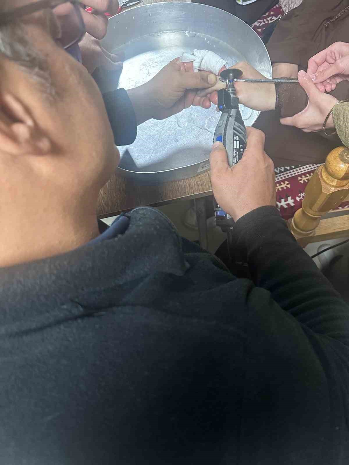 BATMAN’DA VATANDAŞIN PARMAĞINA SIKIŞAN YÜZÜK HASTANEDE ÇIKARILDI