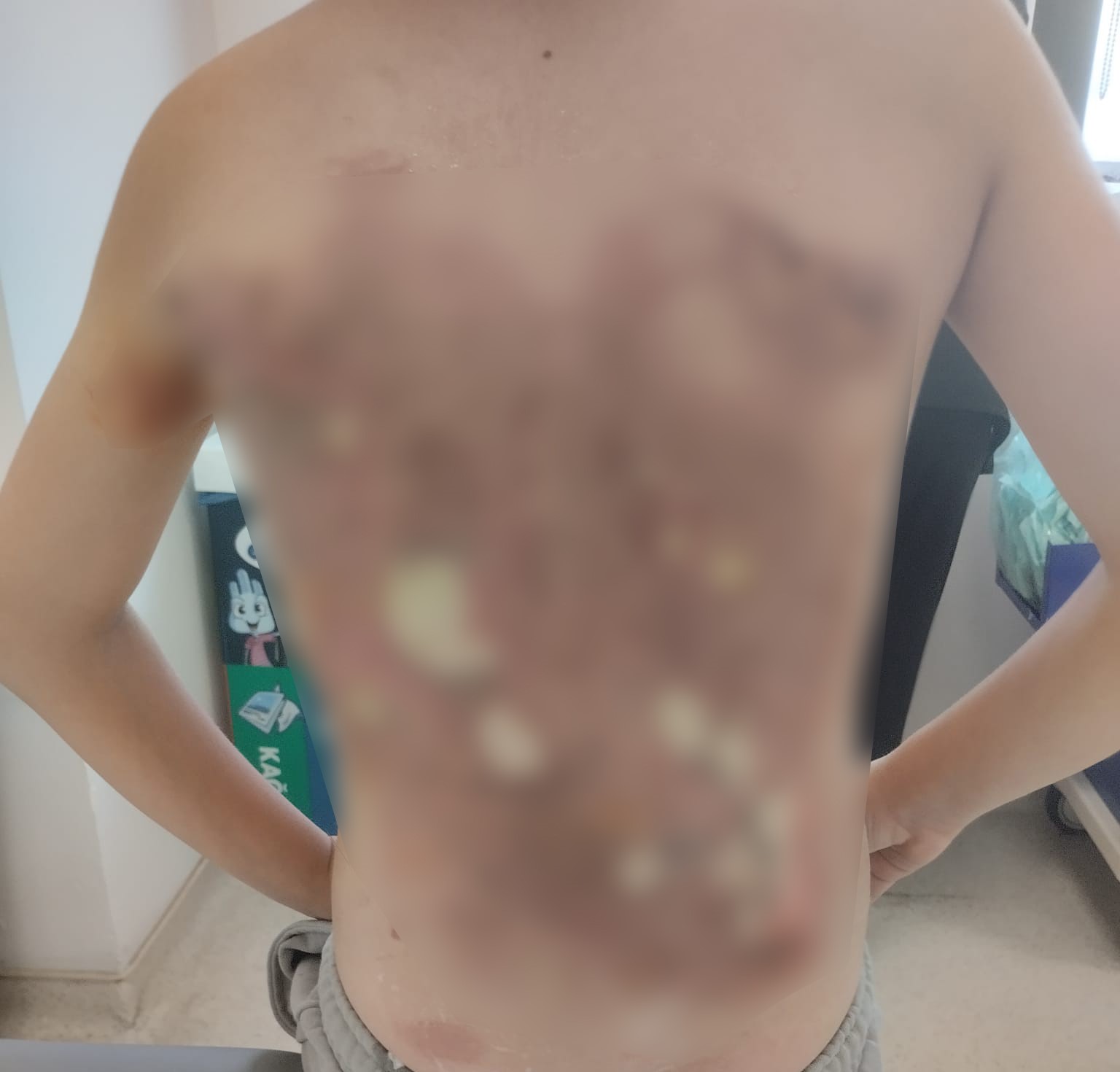 ARNAVUTKÖY’DE AKRAN ZORBALIĞI İDDİASI: 12 YAŞINDAKİ ÇOCUĞUN SIRTINI KOLONYA İLE YAKTILAR